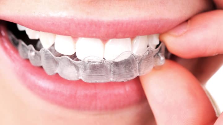 Invisalign Clear Orthodontic Aligners