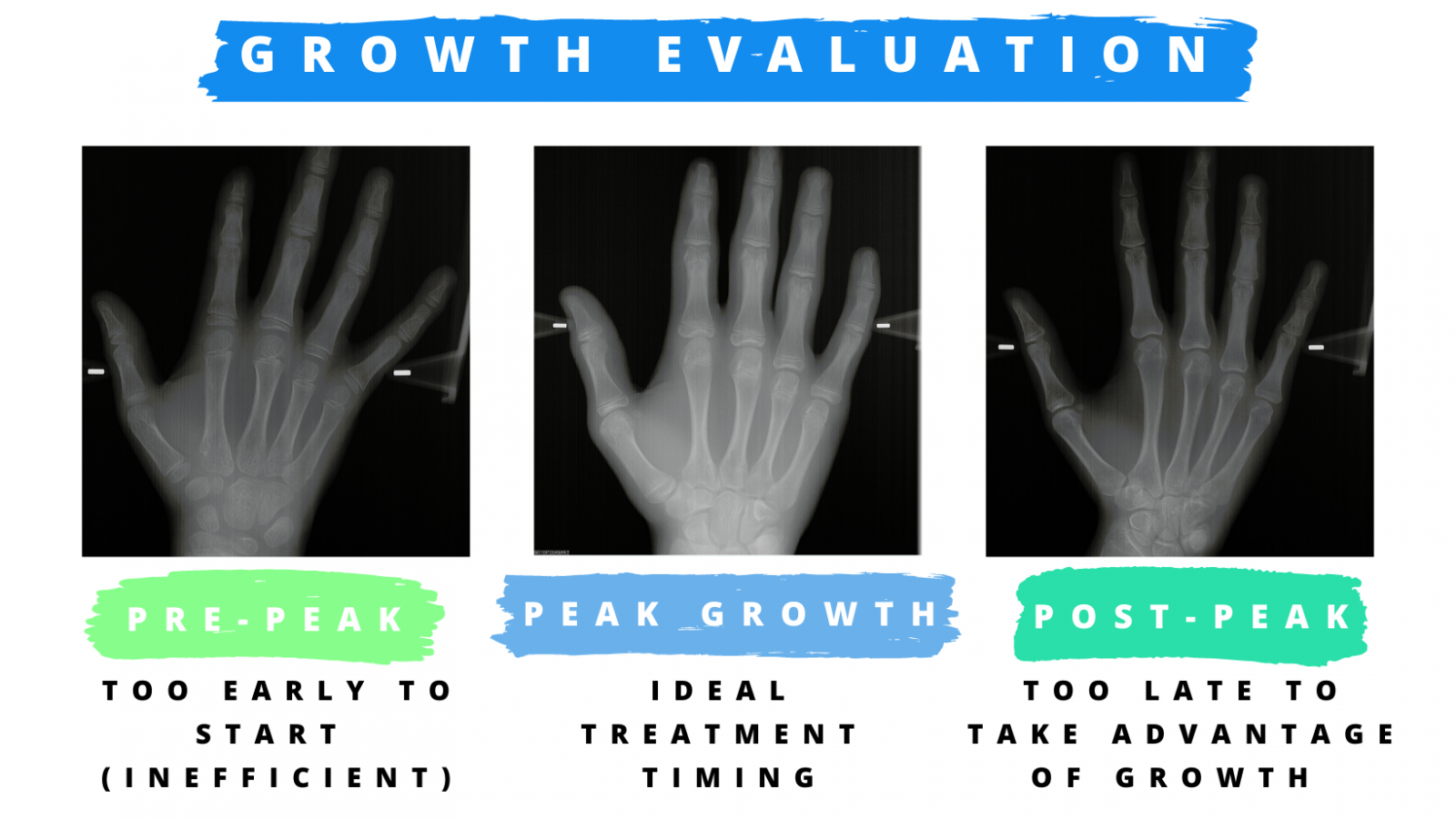 Handwrist Radiograph Growth Evaluation