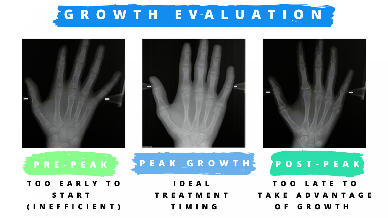 Handwrist Xray Evaluation for Braces