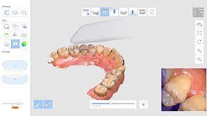 3D Orthodontic Tooth Scan